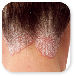 Psoriasis
