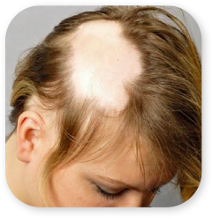 Alopecia Areata